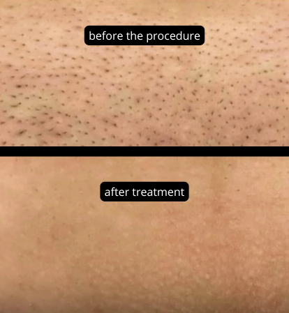 Сравнение состояния кожи до и после процедуры улучшения ее внешнего вида. DL 6000 Pro 4