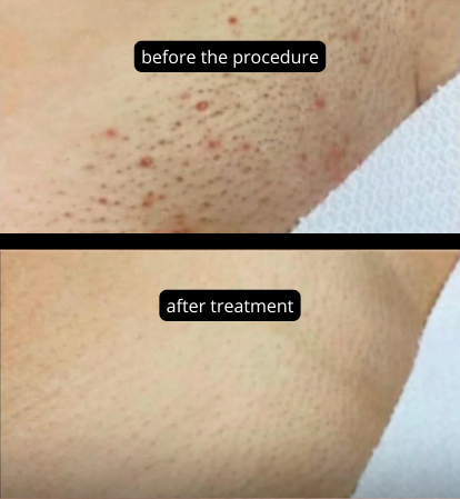 Сравнение состояния кожи до и после процедуры с использованием DL 6000 Pro 4.