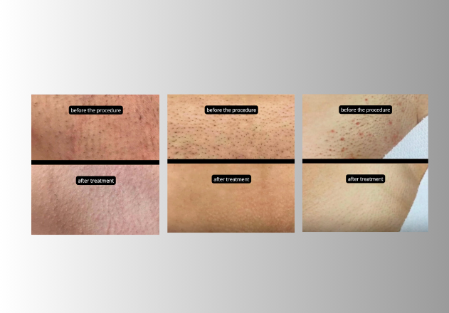 Результаты процедур до и после с использованием DL 6000 Pro 4 для улучшения кожи.